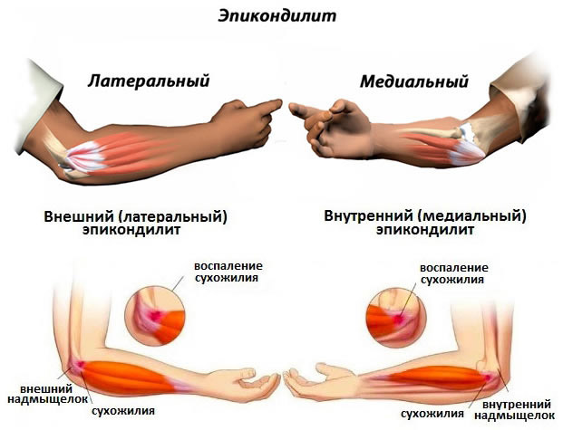 эпикондилит локтевого сустава